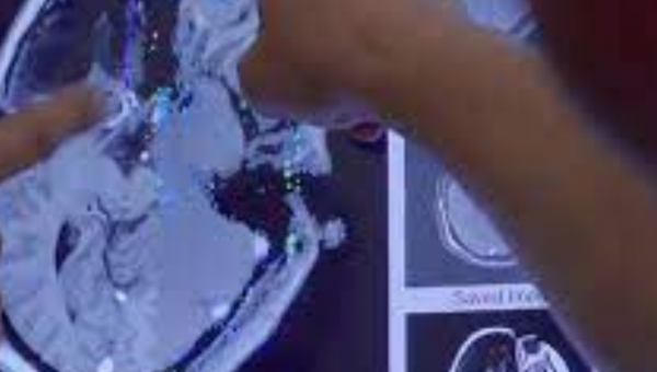 إجراء عملية الاستئصال بالليزر لعلاج الصرع في الهند